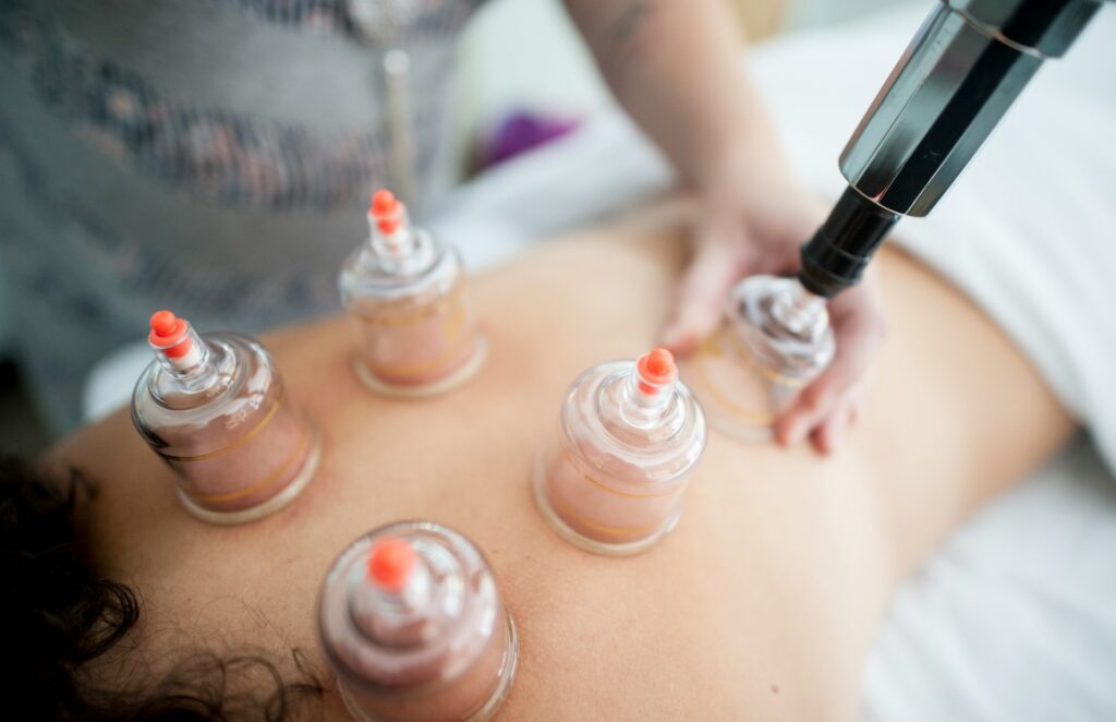 Cupping therapy a cosa serve - Scopri i benefici antichi